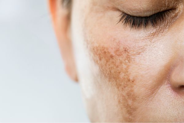 A woman with hyperpigmentation caused by hormonal changes, seeking treatment and prevention