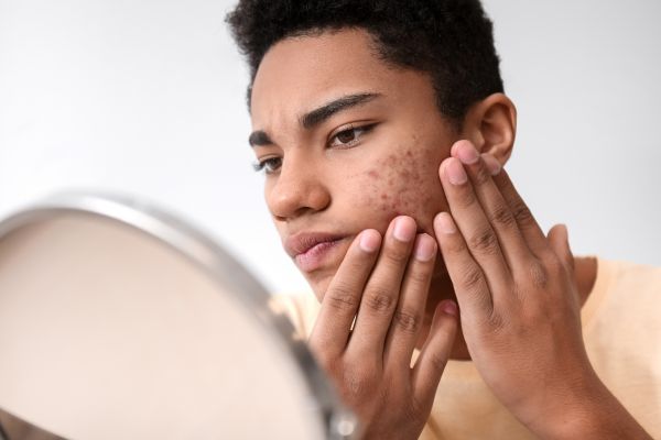 A boy using teen acne skincare recommended by a plastic surgeon