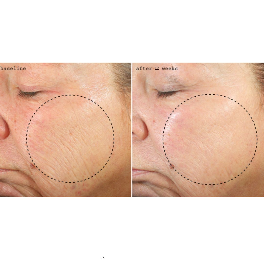 THD-Ascorbate Vitamin C Serum before and after. Independent 12-week consumer perception study, 33 women ages 40-65. 94% reported brighter, more even skin tone. 91% reported improved skin texture and smoothness. Unretouched photos. Dr. Koo Private Practice Skincare.