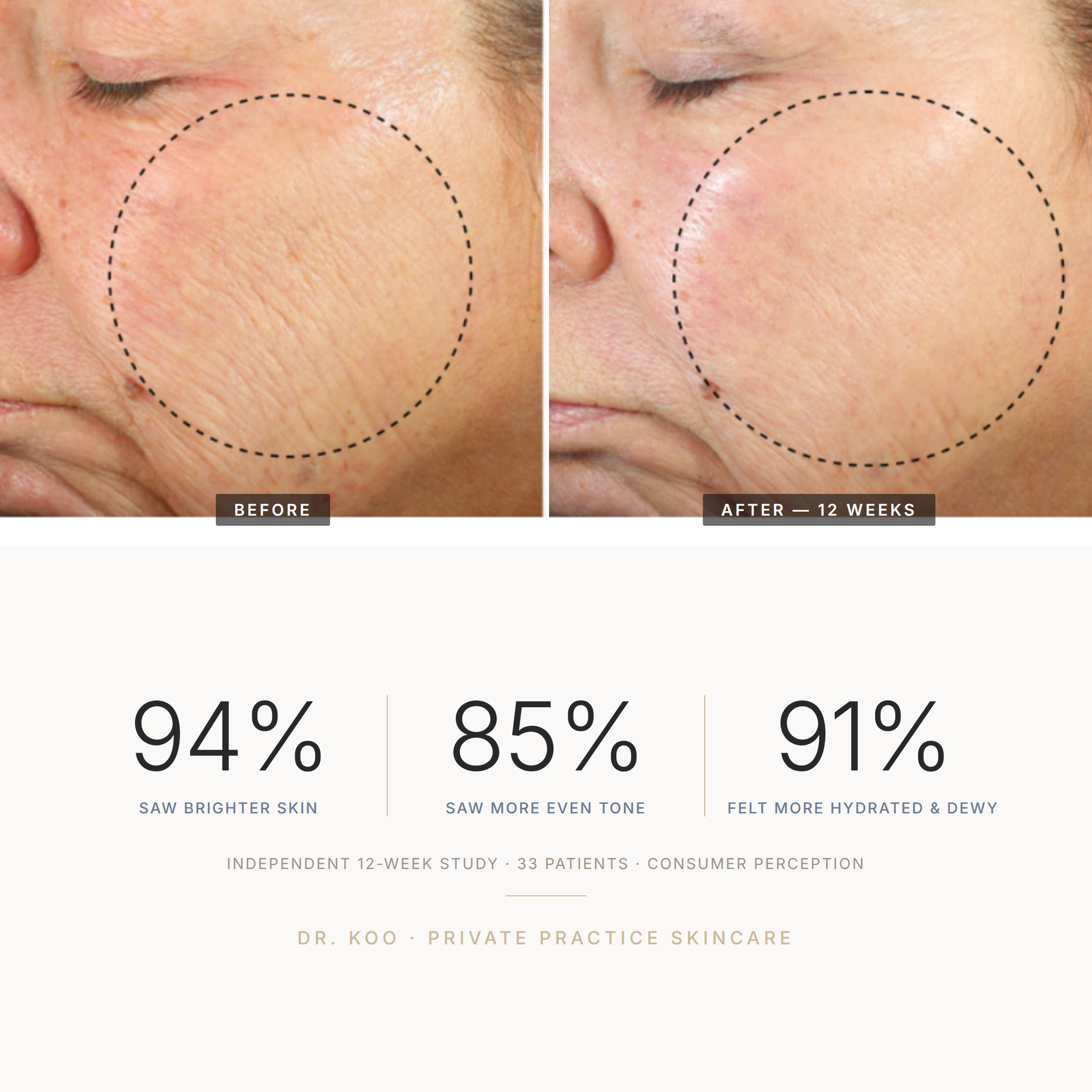 Before and after — 12-week THD-Ascorbate study, 33 patients: 94% saw brighter skin, 85% saw more even tone, 91% felt skin more hydrated & dewy (consumer perception)